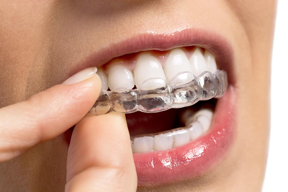 Nouvel appareil orthodontique dentaire Alignement Er pour adulte