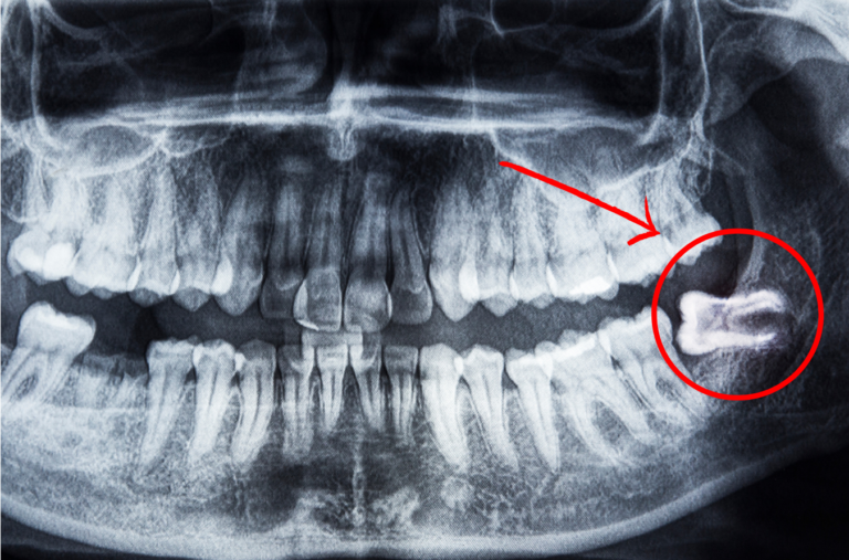 Wisdom tooth