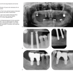 Radiographie dentaire montrant des implants et des dents naturelles dans la mandibule postérieure.