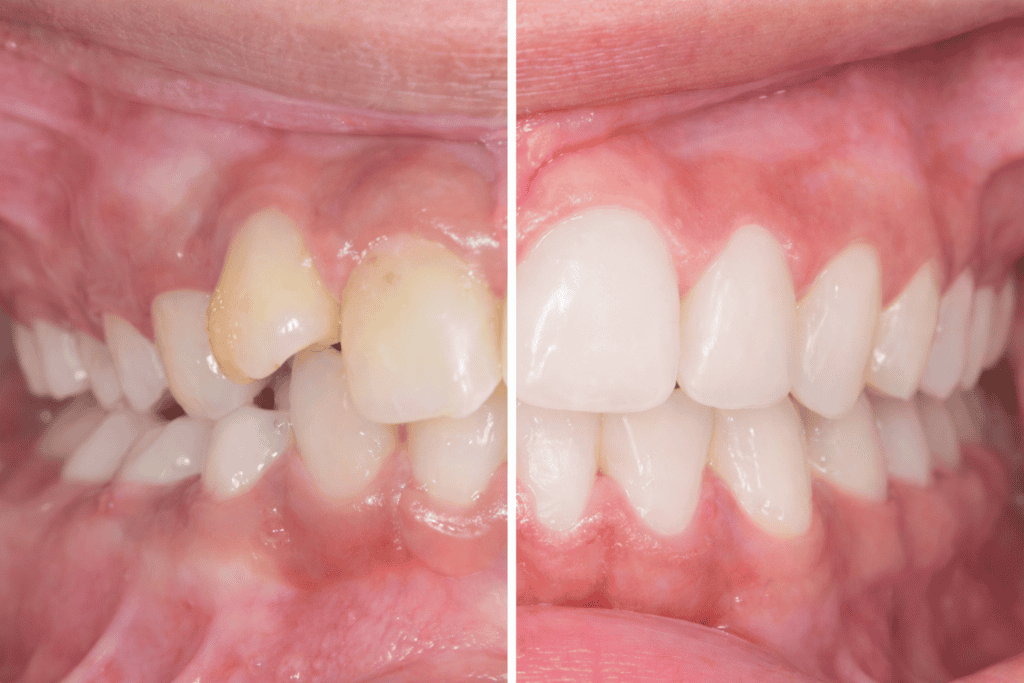 Orthodontic treatment results showing improved teeth alignment and oral health.