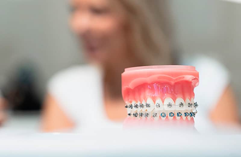Modèle de dentier avec appareils orthodontiques en métal, illustrant les soins dentaires et l'orthodontie pour un sourire aligné et sain.