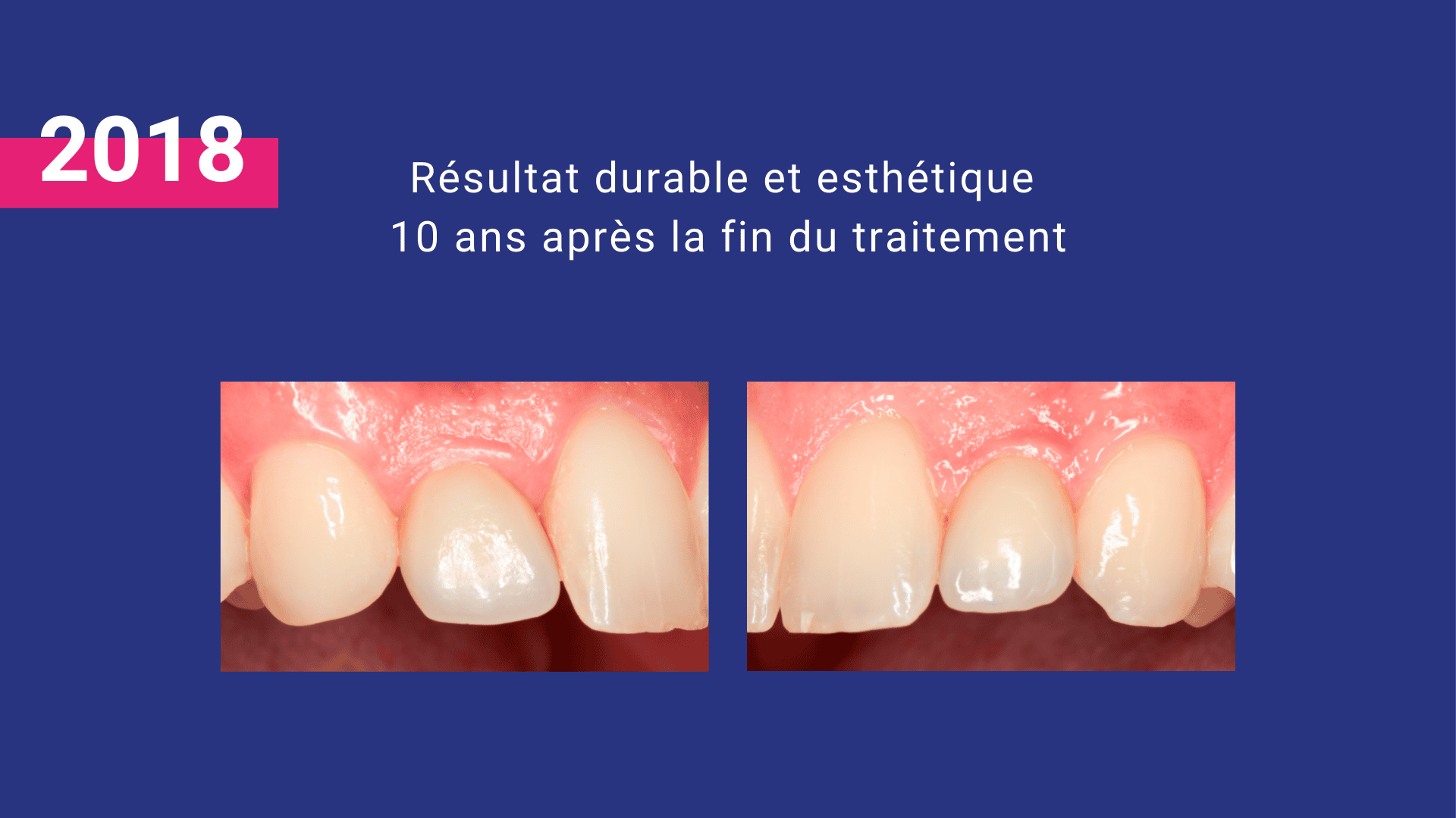 malformation buccale agénésie non-formation des dents définitives implant couronne greffe osseuse orthodontie