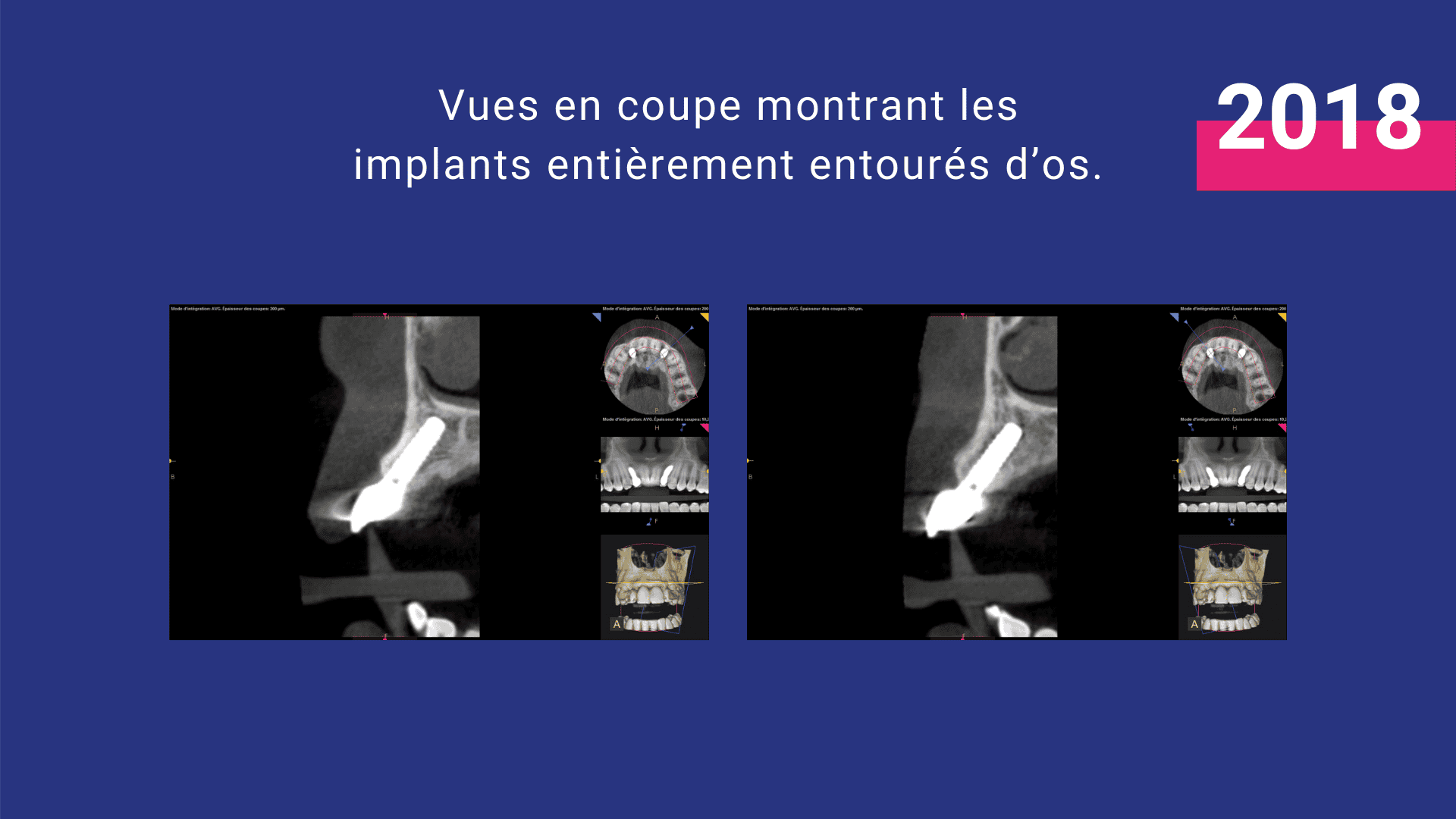 malformation buccale agénésie non-formation des dents définitives implant couronne greffe osseuse