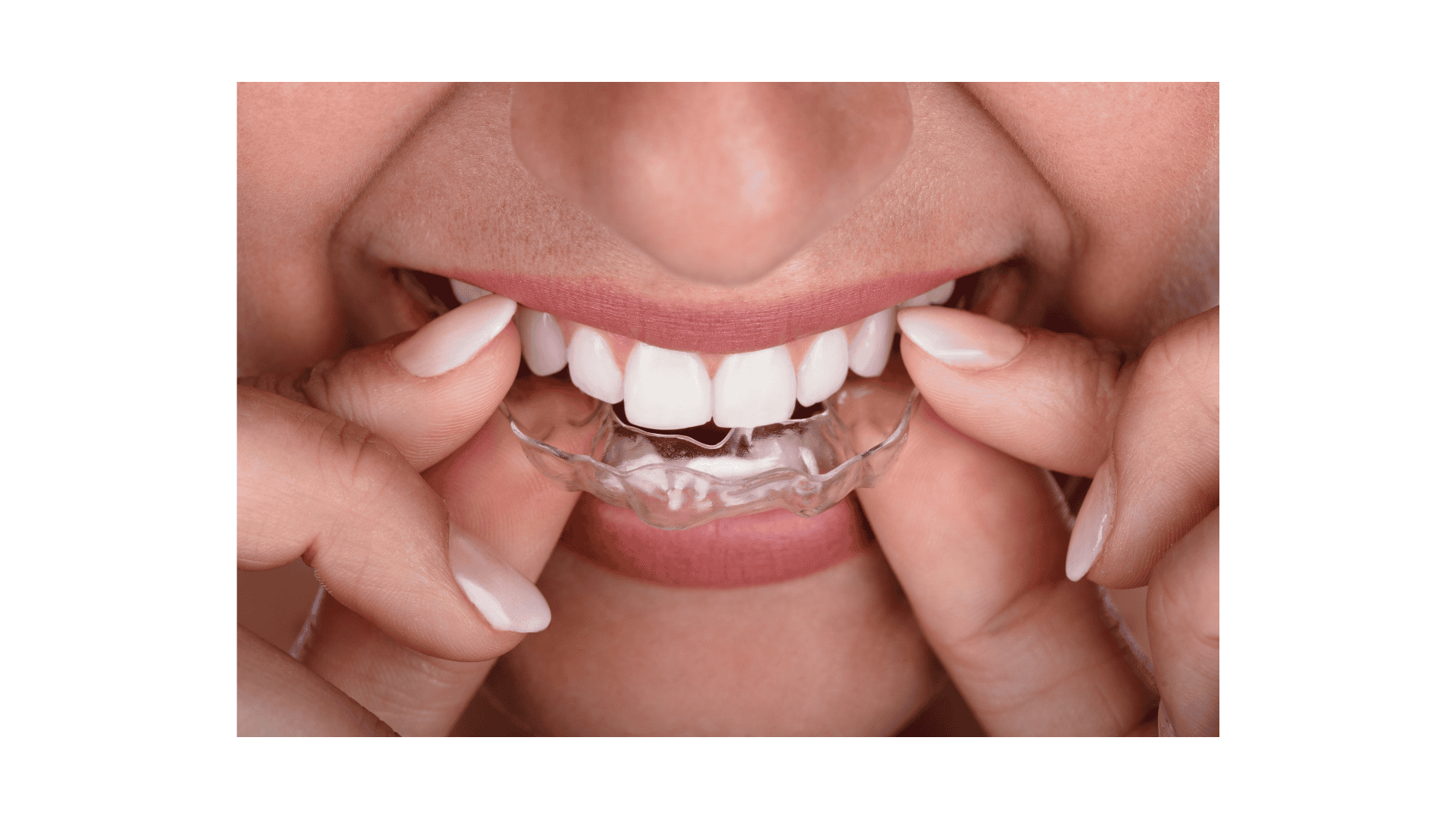 gouttières dents