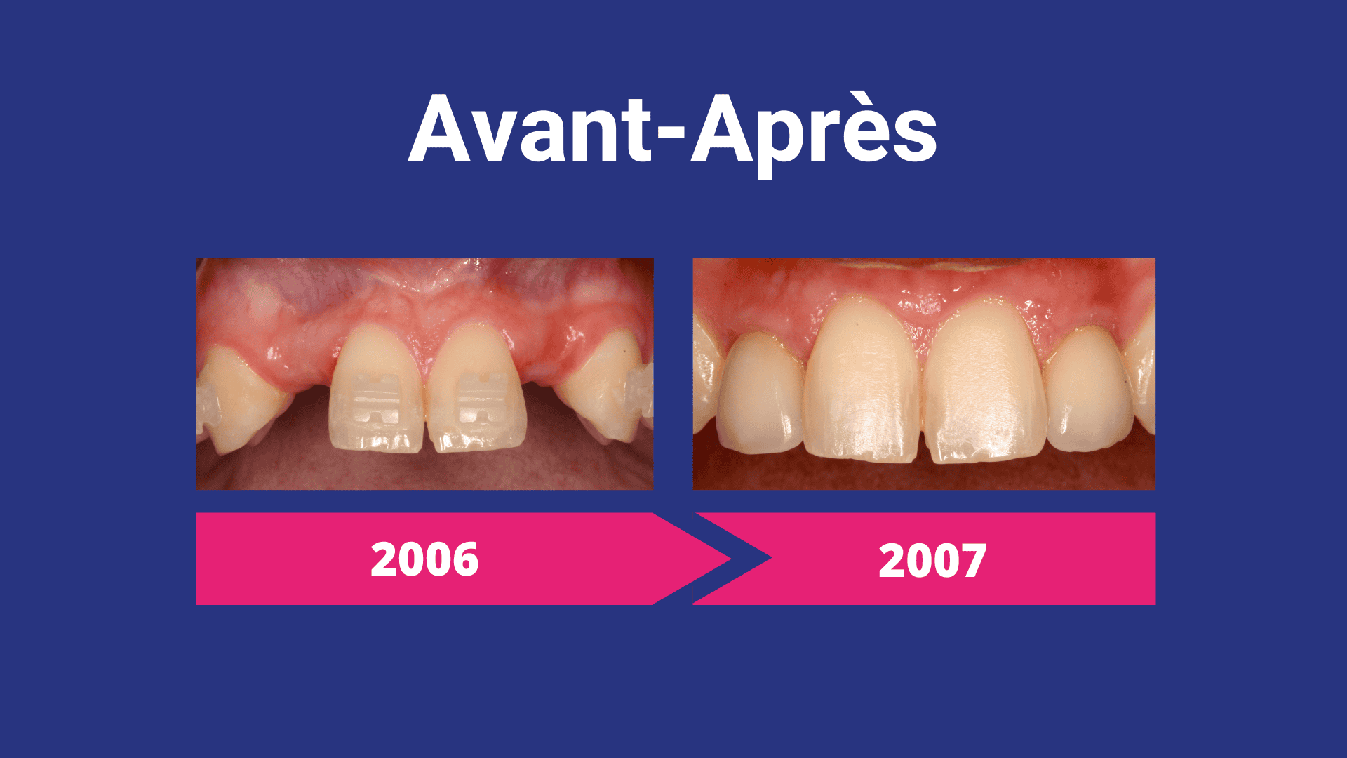 malformation buccale agénésie non-formation des dents définitives implant couronne greffe osseuse orthodontie avant-après