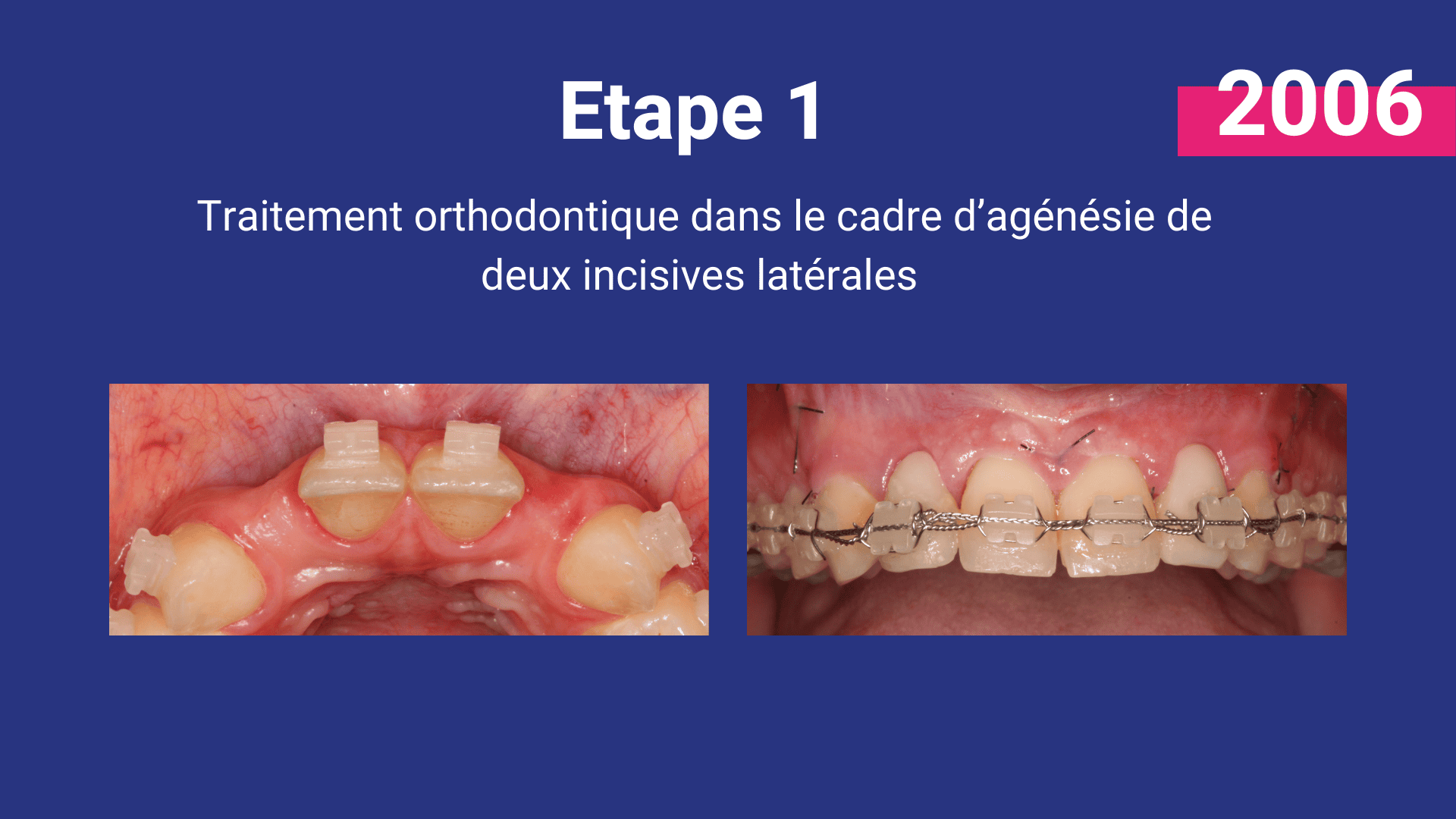 malformation buccale agénésie non-formation des dents définitives implants couronnes greffe osseuse orthodontie