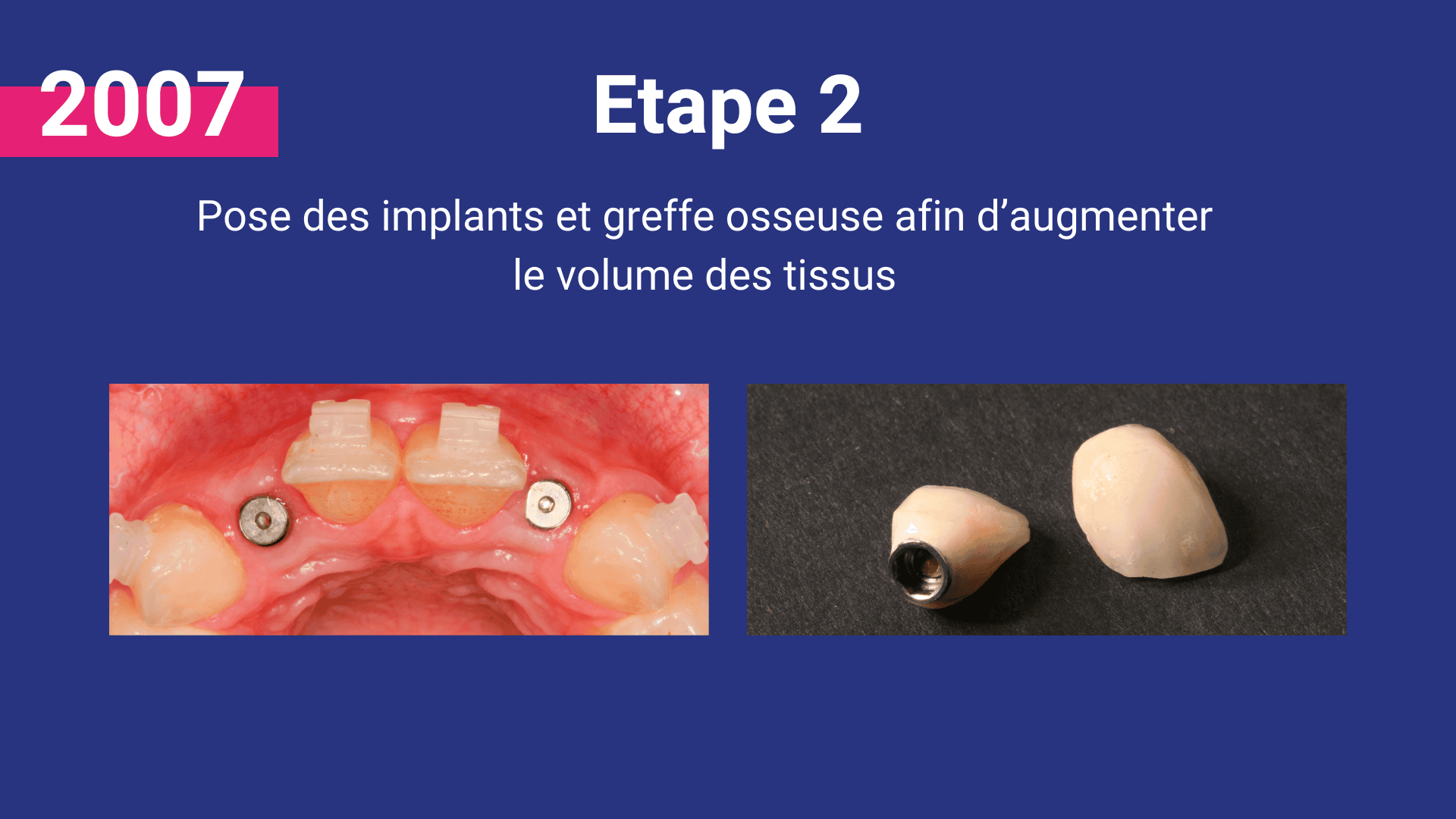 malformation buccale agénésie non-formation des dents définitives implant couronne greffe osseuse