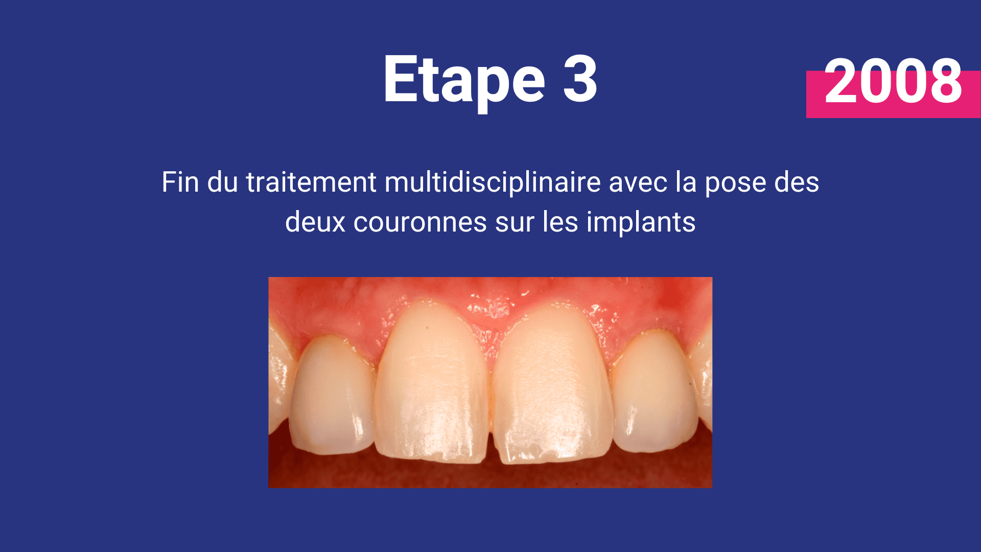 malformation buccale agénésie non-formation des dents définitives implant couronne greffe osseuse orthodontie