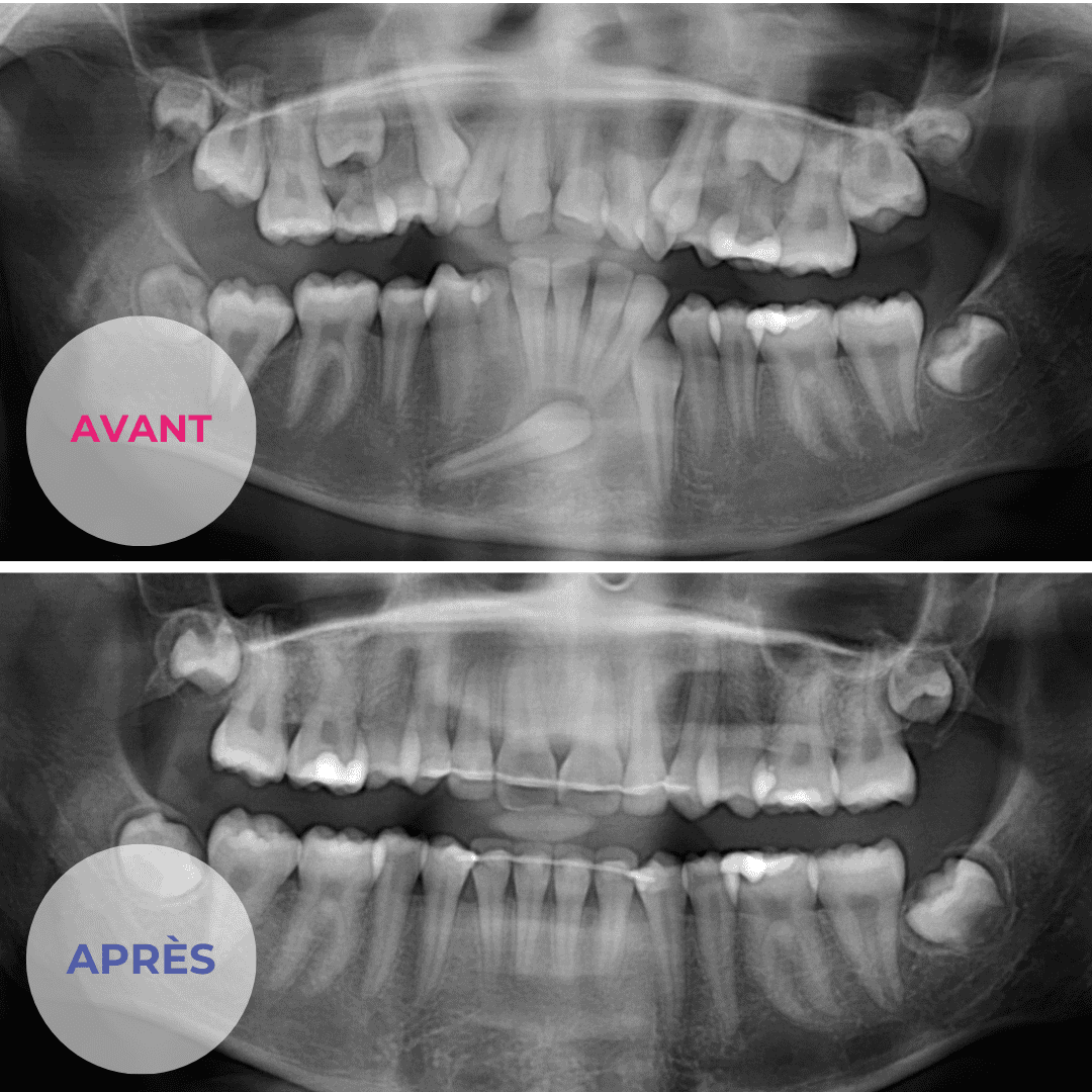 radiographie dents